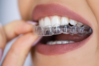 Clear Braces and Teeth Aligners in 77079 Houston - GB Dentistry