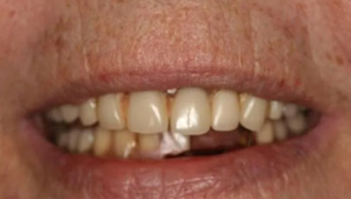 Before Image - GB Dentistry