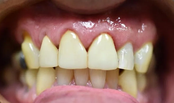 Dental Crowns After - GB Dentistry