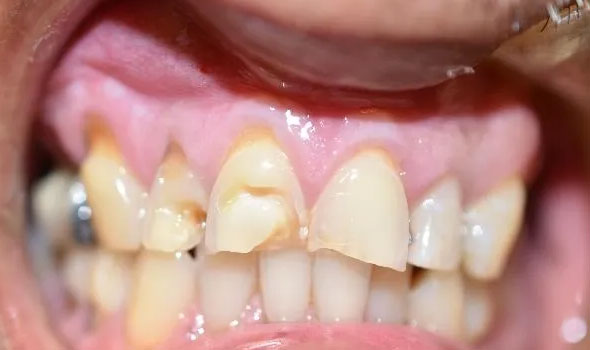 Dental Crowns Before - GB Dentistry