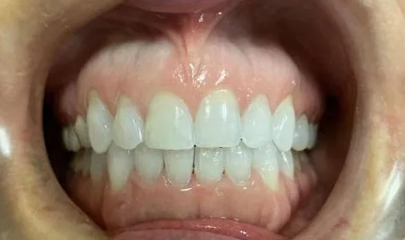 Invisalign 1 After - GB Dentistry