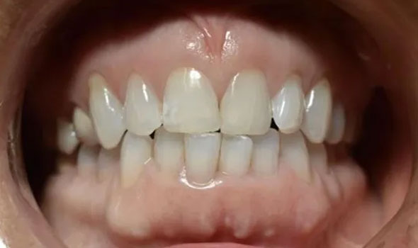 Invisalign 1 Before - GB Dentistry