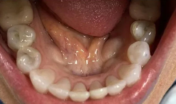 Invisalign 2 After - GB Dentistry
