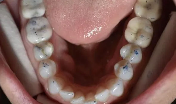 Invisalign 2 Before - GB Dentistry