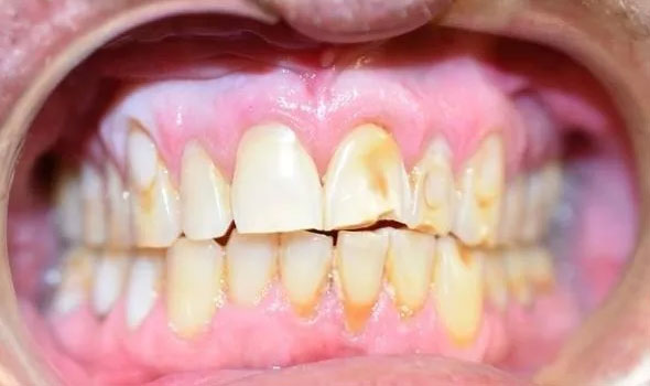 Smile Restoration 1 Before - GB Dentistry