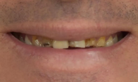 Smile Restoration 2 Before - GB Dentistry