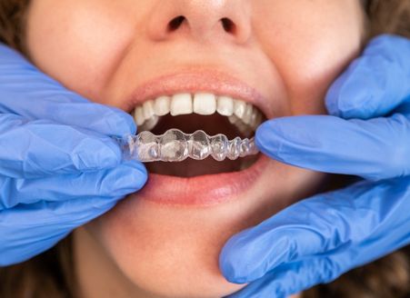 TMJ and Bruxism Relief in Memorial - GB Dentistry
