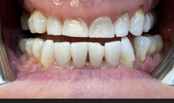 Teeth Whitening After- GB Dentistry