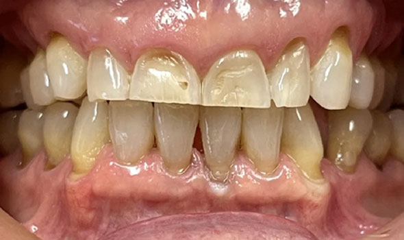 Teeth Whitening Before - GB Dentistry