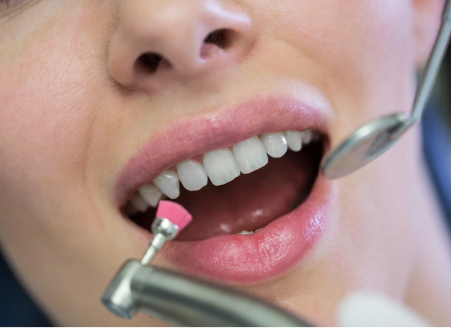 Teeth Whitening - GB Dentistry