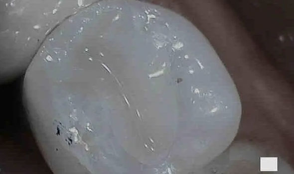 Tooth-Colored Fillings After - GB Dentistry
