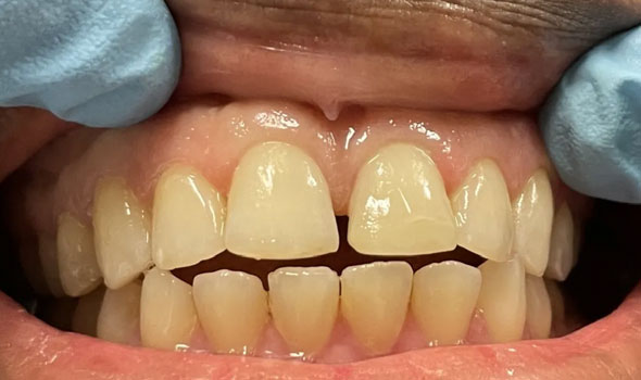 Tooth-Colored Fillings After - GB Dentistry