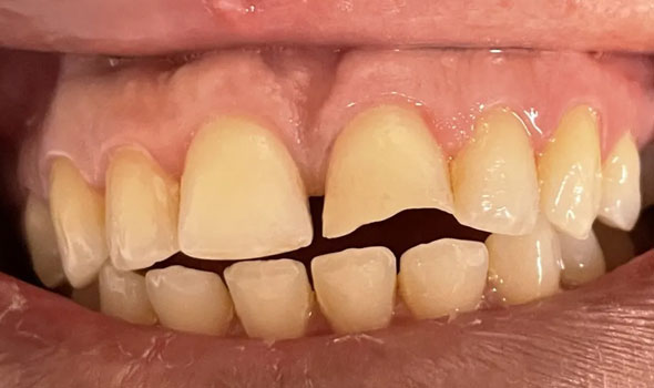 Tooth-Colored Fillings Before - GB Dentistry