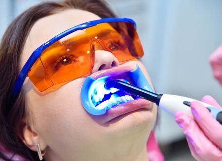 Tooth Colored Fillings Services in Memorial - GB Dentistry