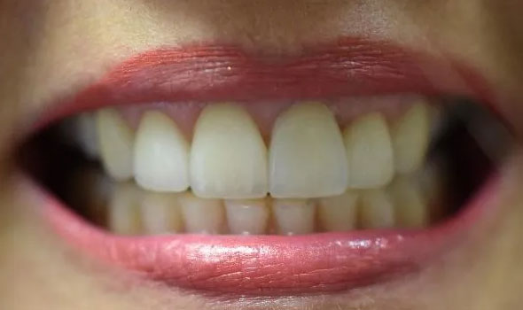Veneers After - GB Dentistry