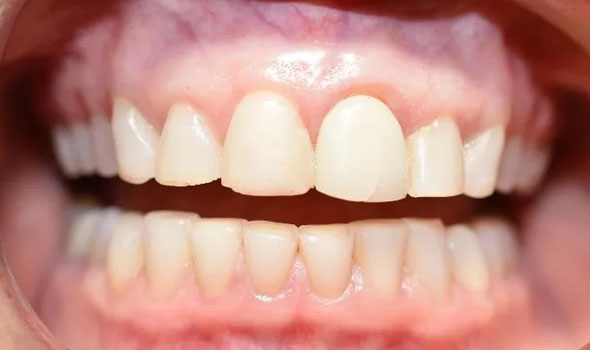 Veneers Before - GB Dentistry