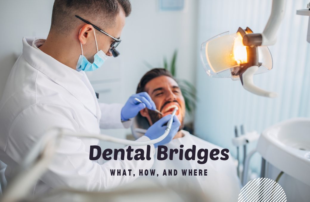 Dental Bridge: What, How, and Where