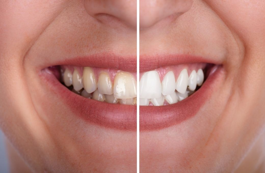 Comparing Results Zoom Whitening vs. At-Home Kits