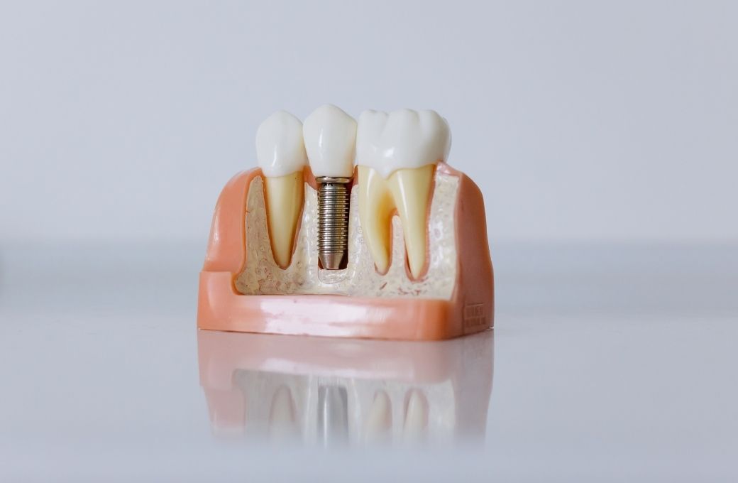 Types of Dental Bridges and Their Costs