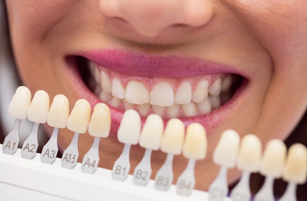 Key Differences Between Composite and Porcelain Veneers
