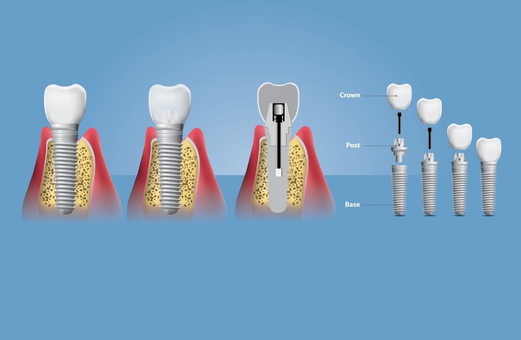 The Purpose and Process of Dental Crowns