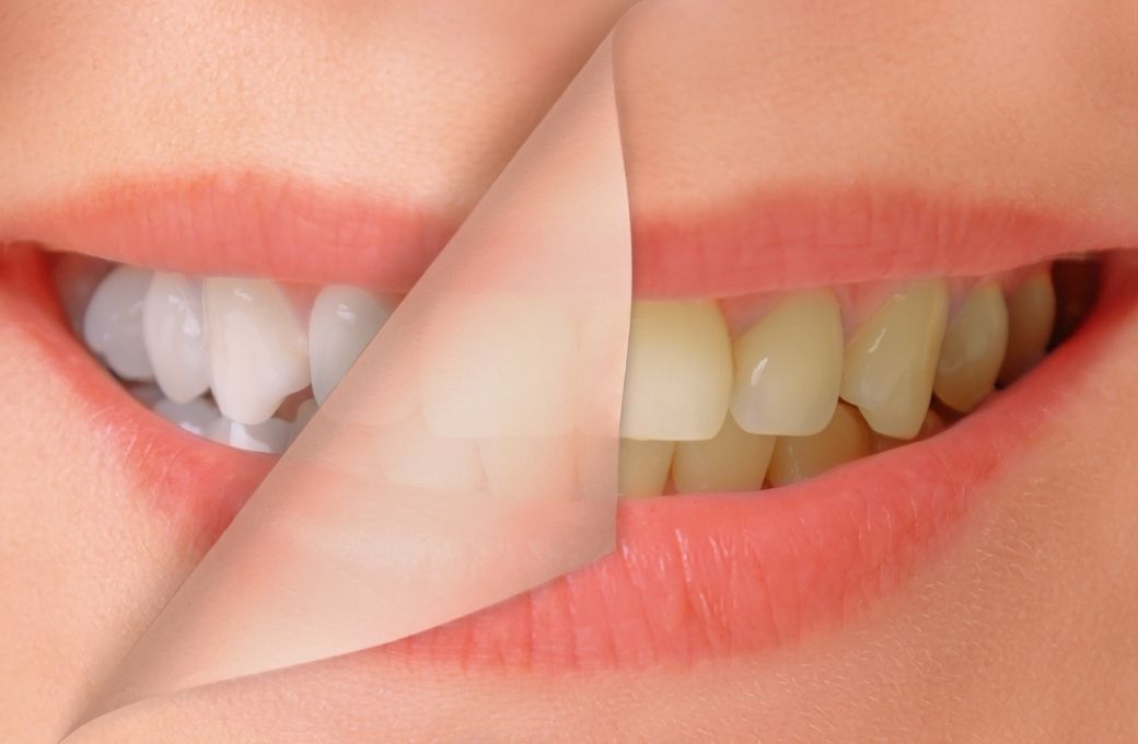 Who Benefits Most from Professional Whitening