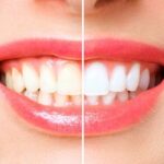 Professional Teeth Bleaching - GB Dentistry
