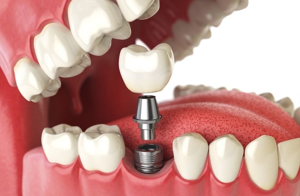 Teeth Crown - GB Dentistry