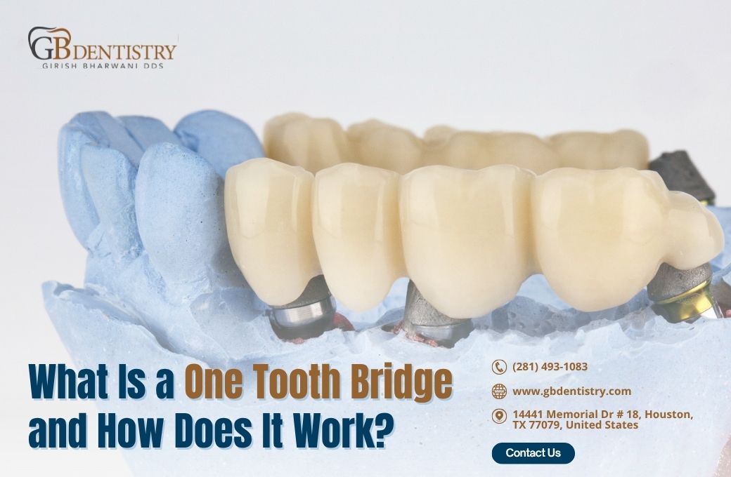 What Is a One Tooth Bridge and How Does It Work?