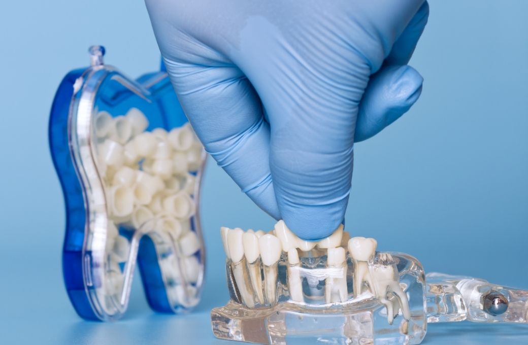 Dental Implants - GB Dentistry