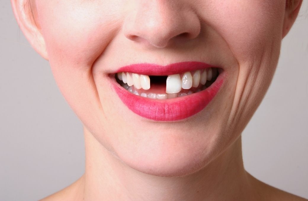 Teeth Bridge Dentist - GB Dentistry