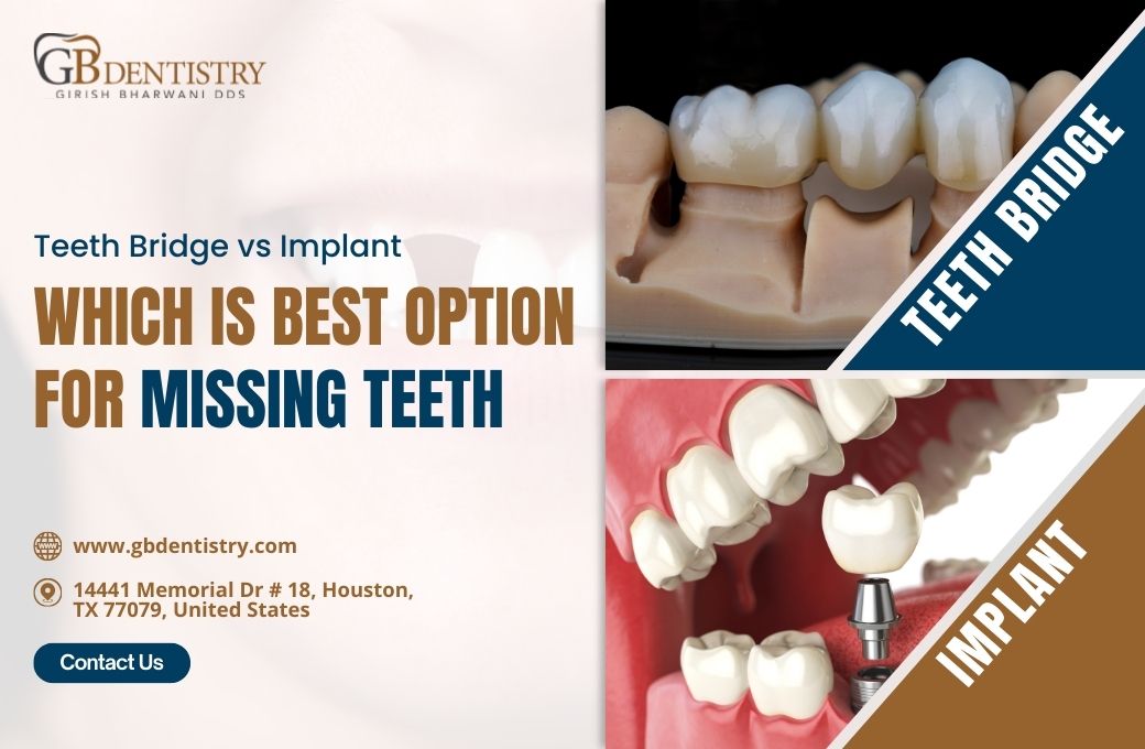 Teeth Bridge vs. Implant: Which is Best Option for Missing Teeth?