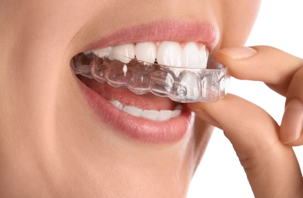 Braces Dentist - GB Dentistry