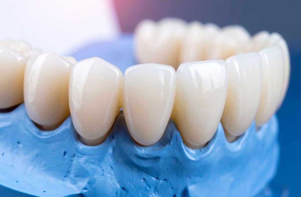 Permanent Bridge Dentist - GB Dentistry