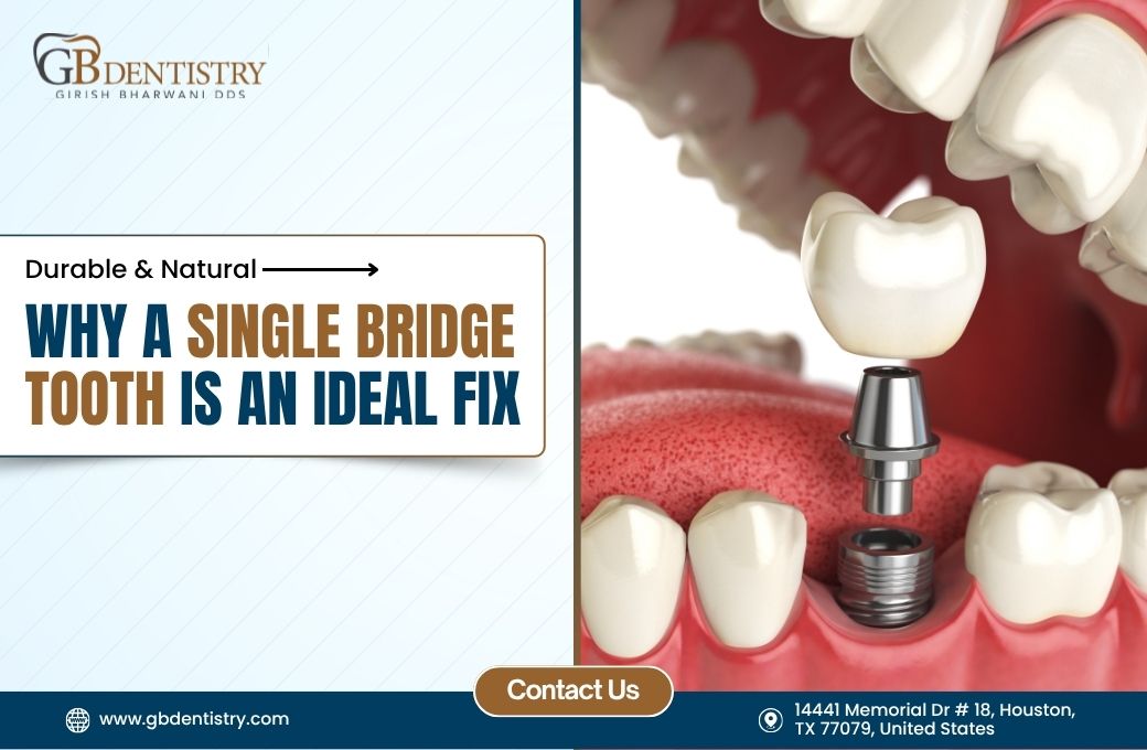 Durable & Natural: Why a Single Bridge Tooth is an Ideal Fix