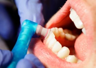 Preventive Care in Memorial - GB Dentistry