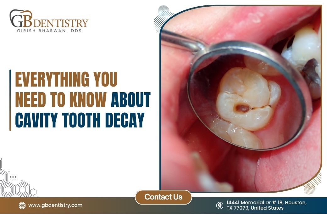 Everything You Need to Know About Cavity Tooth Decay